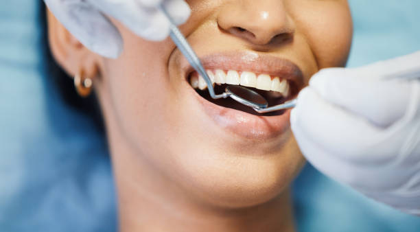 Best Emergency Dentist for Lost Fillings or Crowns in Boalsburg, PA